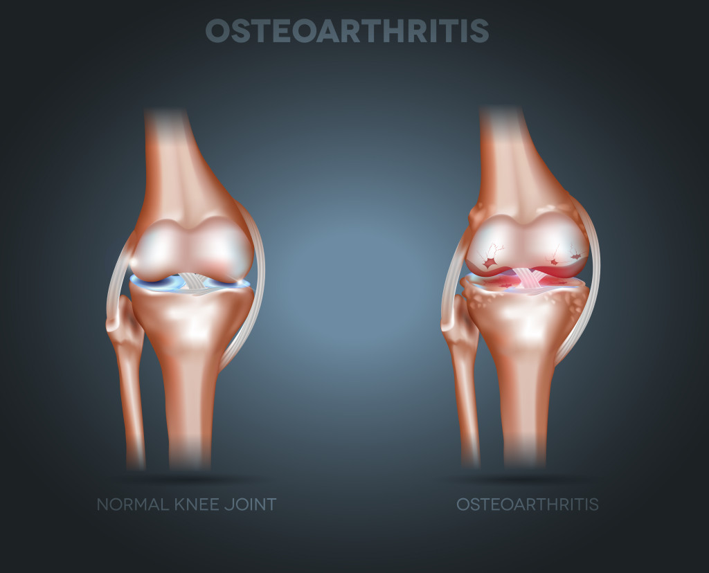 What is the recovery time after partial knee replacement surgery?