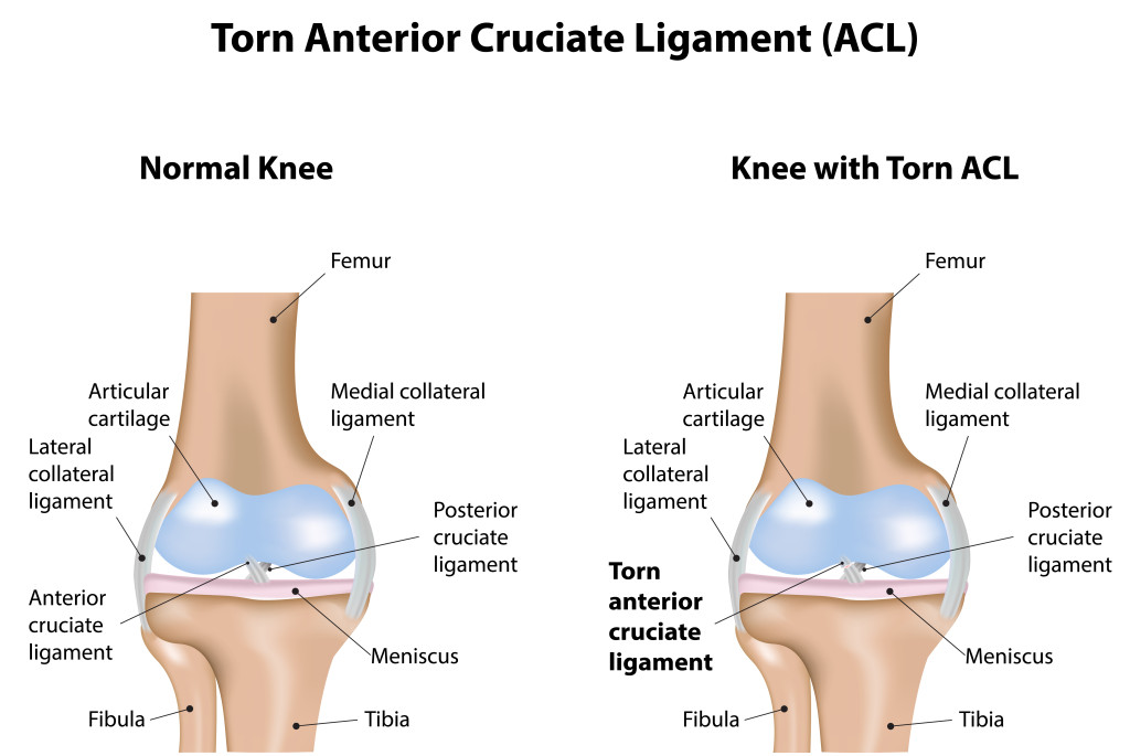 ACL Injury - The Comprehensive Guide to Anterior Cruciate Ligament Tear &  Sprain!