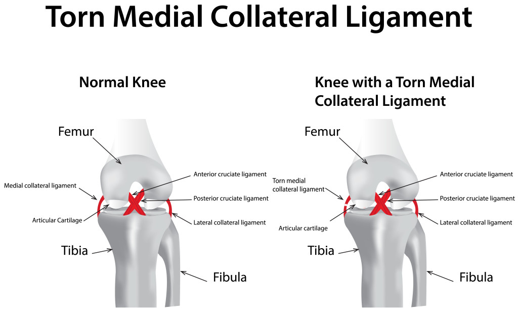 Medial Collateral Ligament (MCL) Sprain - Fantasy Injury Team