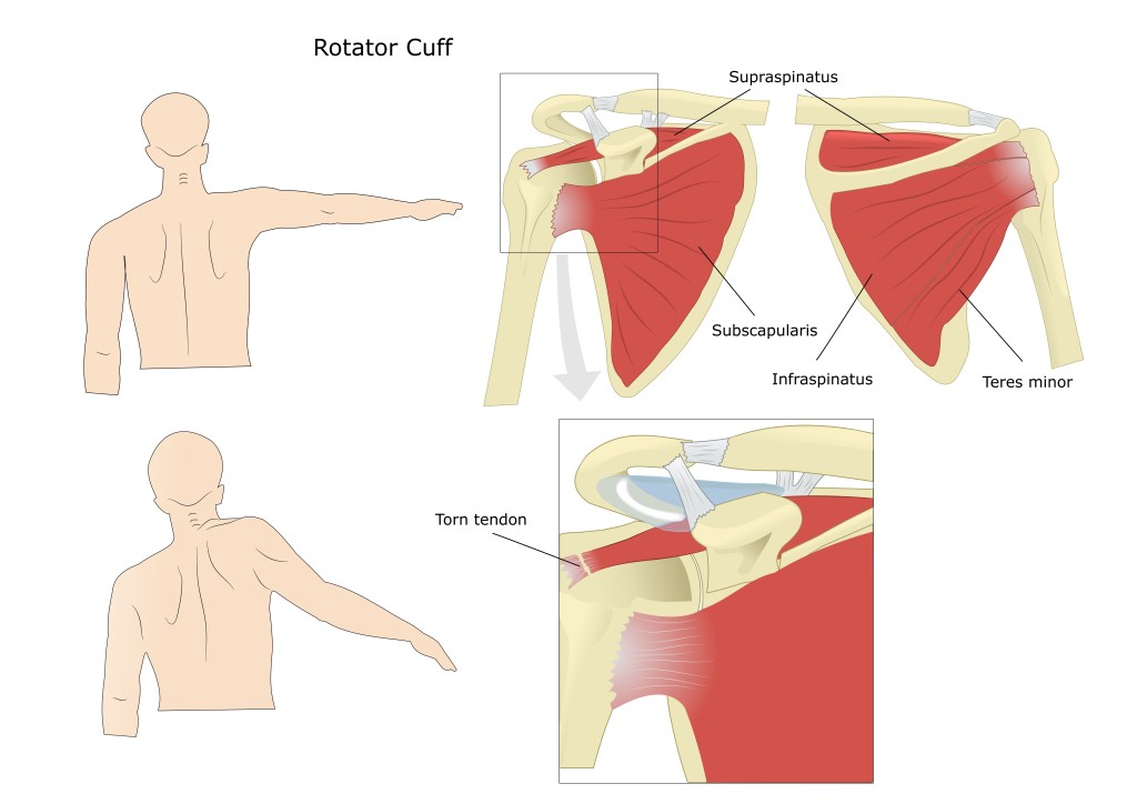 Modes of rotator cuff failure. Notes: ( A ) Intact repair on MRI. Note