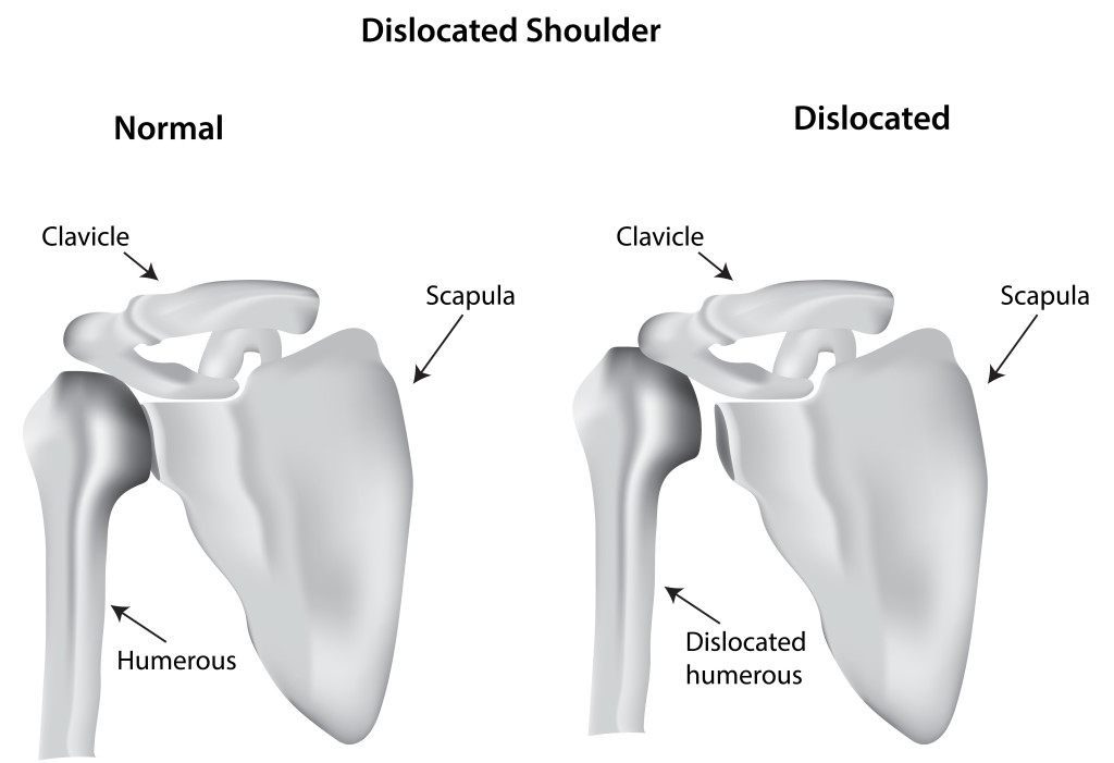 Shoulder Dislocation Diagram
