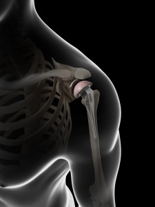 Shoulder Replacement Burr Ridge IL