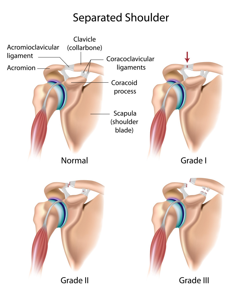 Shoulder Separation Burr Ridge IL